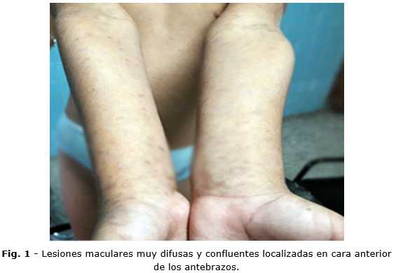 Dermatosis cenicienta en edad pediátrica | Nieto Jiménez | Folia  Dermatológica Cubana